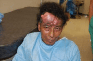 Sasson Plastic Surgery Dog Bite Victim