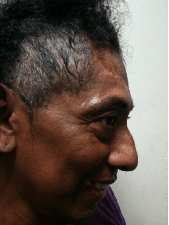 Sasson Plastic Surgery Dog Bite Victim