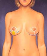 A medical concept of a woman that underwent a breast reduction with tiny incisions around her areolaa