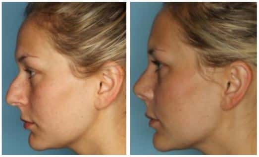 Rhinoplasty nose job Great Neck, NY Sasson Plastic Surgery