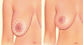 breast-lift-1