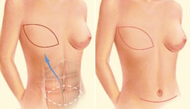 breast-reconstruction-1