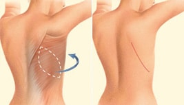 breast-reconstruction-2