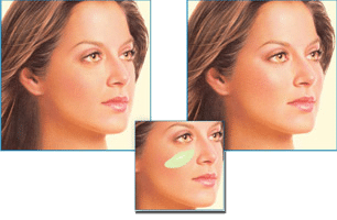 cheek-implants Great Neck, NY