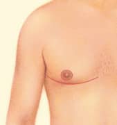 male-breast_excision-lipo-02
