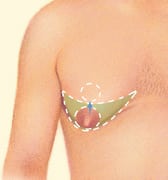 male-breast_excision-lipo