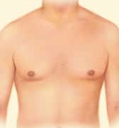 male-breast_liposuction-01