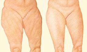 medial-thight-lift