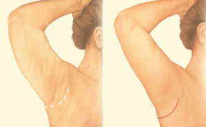 minimal-arm-lift-incision