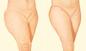 outer-thigh-lift