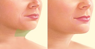under-the-chin-liposuction