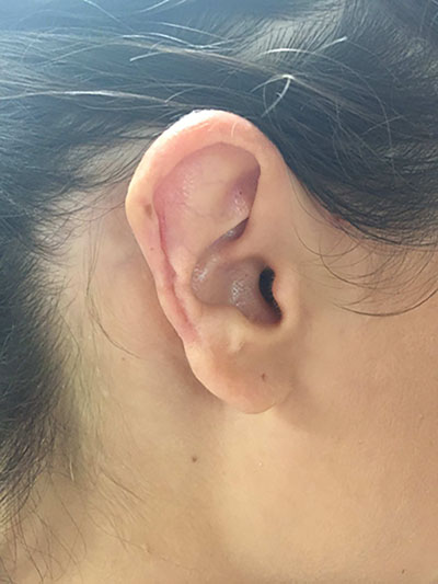 ear2