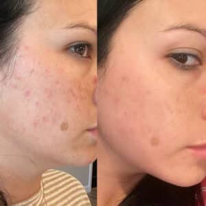 before and after of side of woman's gace showing decrease in acne/scarring