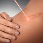 Female shoulder and laser beam during scar removal treatment