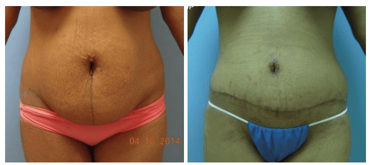 Before and After Image of Tummy Tuck (Abdominoplasty)