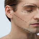 Young man with surgical lines on face before plastic surgery, preparing for facial implants and cosmetic treatment