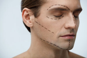 Young man with surgical lines on face before plastic surgery, preparing for facial implants and cosmetic treatment