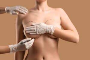 Plastic surgeon marking woman's breast in preparation for breast augmentation surgery, highlighting preoperative planning and precision.