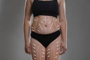 Close-up of body with contouring lines and arrows for plastic surgery, showing tummy tuck and figure correction