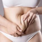 Improved abdominal contour after a post-pregnancy tummy tuck procedure.