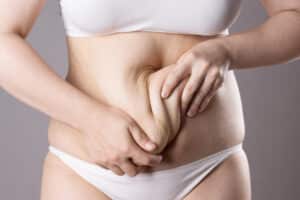 Improved abdominal contour after a post-pregnancy tummy tuck procedure.