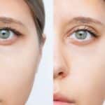 Before and after correction of a droopy upper eyelid surgery