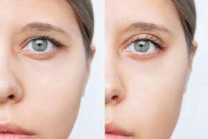Before and after correction of a droopy upper eyelid surgery
